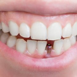 Smile with dental implant