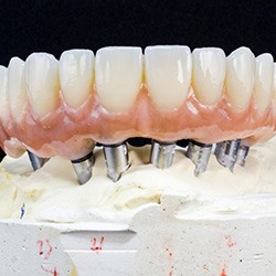 Example of tooth replacements in Garland