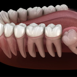 Illustration of impacted tooth in gum tissue